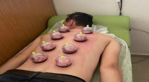 Yerköy Devlet Hastanesinde Hacamat ve Akupuntur tedavisi